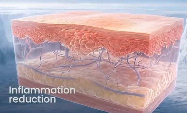 cryo treament for inflammation reduction